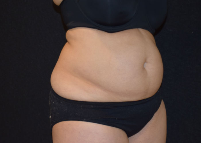 Close-up of a person's midsection showing belly and wearing black undergarments, against a black background. Saxon MD