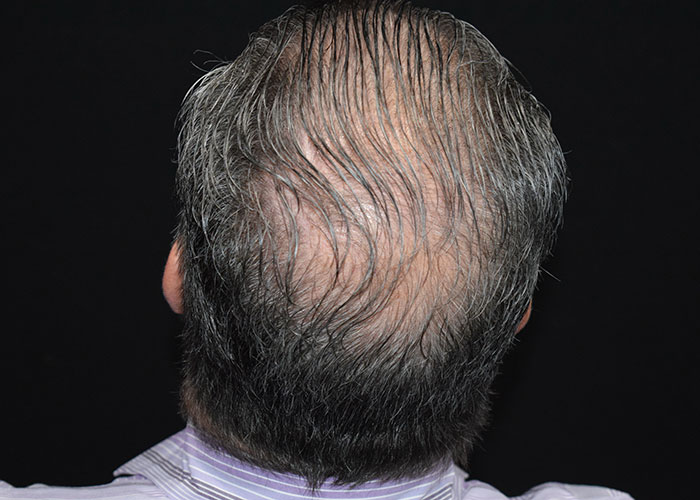 A man with a receding hairline and thinning hair, photographed from behind against a black background. Saxon MD