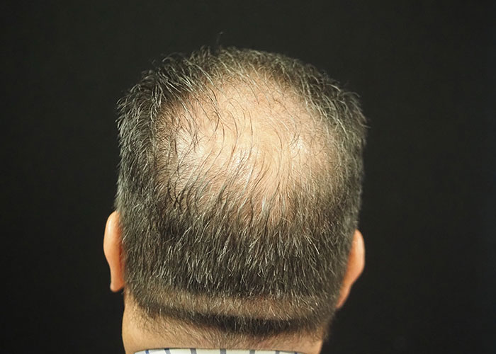 A man's head exhibiting signs of male pattern baldness with thinning hair on the crown, viewed from above against a black background. Saxon MD