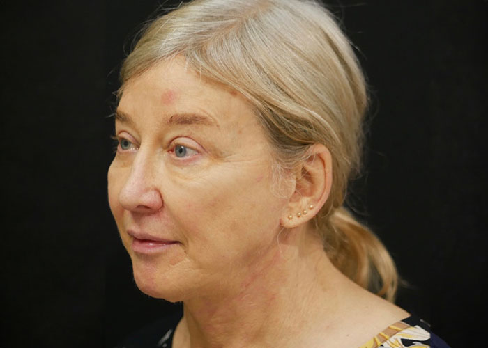 Profile view of an elderly woman with blonde hair tied back, featuring a red mark above her left eyebrow, set against a black background. Saxon MD