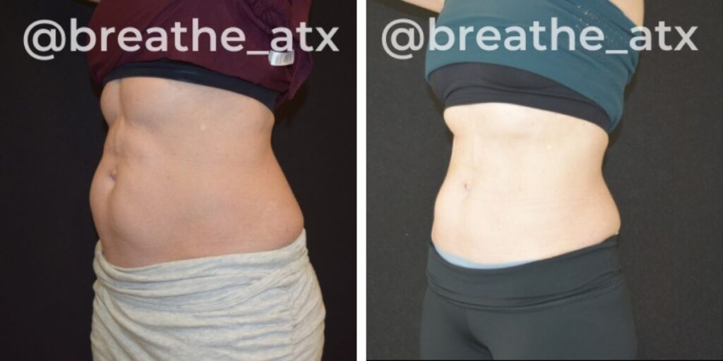 Two side-by-side images showing the torso of a person before and after weight loss, tagged with "@breathe_atx". Saxon MD