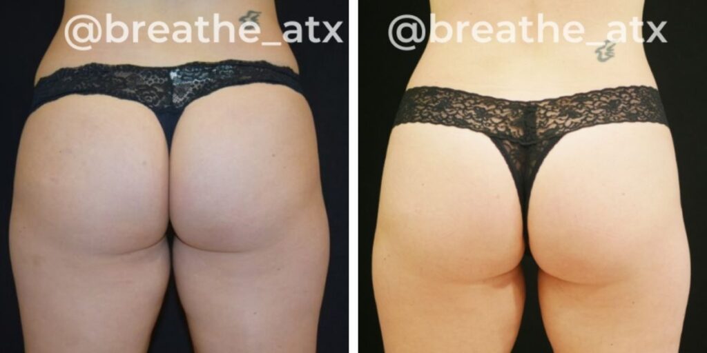 Before and after comparison of a buttock enhancement, showing the results in similar lace underwear, each side marked with a watermark. Saxon MD