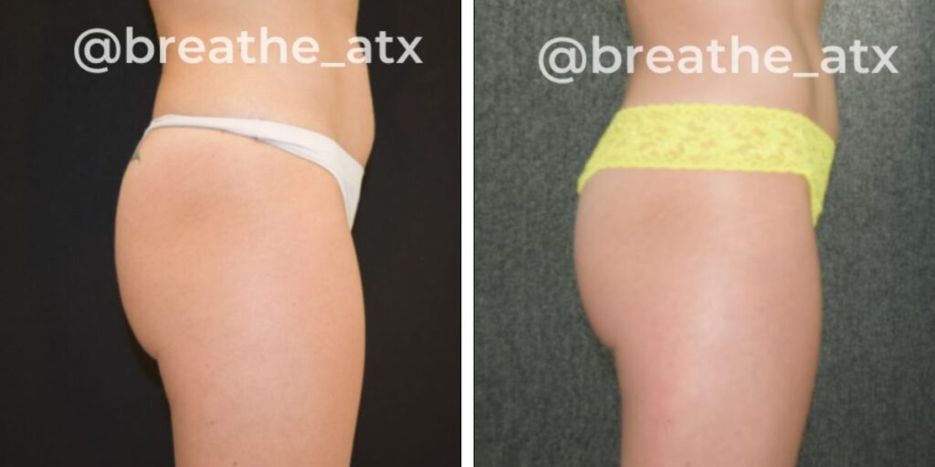 Before and after comparison of cellulite treatment on a person's thighs; the left shows visible cellulite, and the right shows smoother skin. both images have the watermark "@breathe_atx. Saxon MD