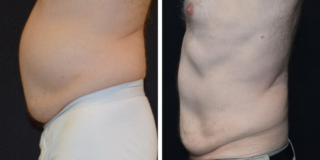 Side-by-side comparison of two male torsos, the left with visible abdominal fat and the right showing a slimmer waistline. Saxon MD