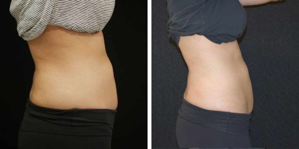 Side-by-side comparison of a person's torso before and after weight loss, showing visible reduction in abdominal fat. Saxon MD