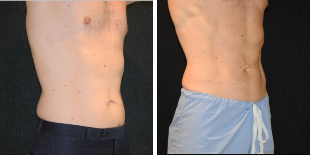 Side-by-side images of a shirtless man's torso: the left shows his front with visible moles and a scar, the right shows his side profile. Saxon MD