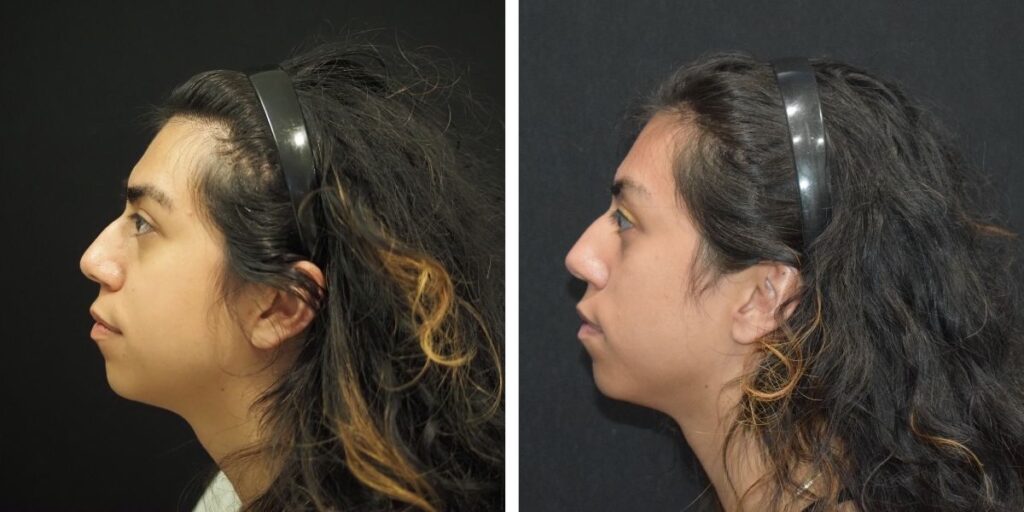 Profile views of a woman with an ombre hairstyle wearing a headband, against a black background. left image shows her facing left, right image shows her facing right. Saxon MD