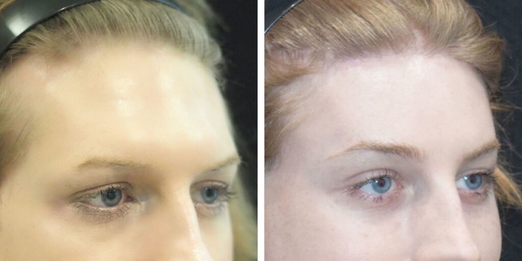 Before and after comparison of a woman's eyebrow microblading treatment, showing enhanced brow shape and fullness. Saxon MD
