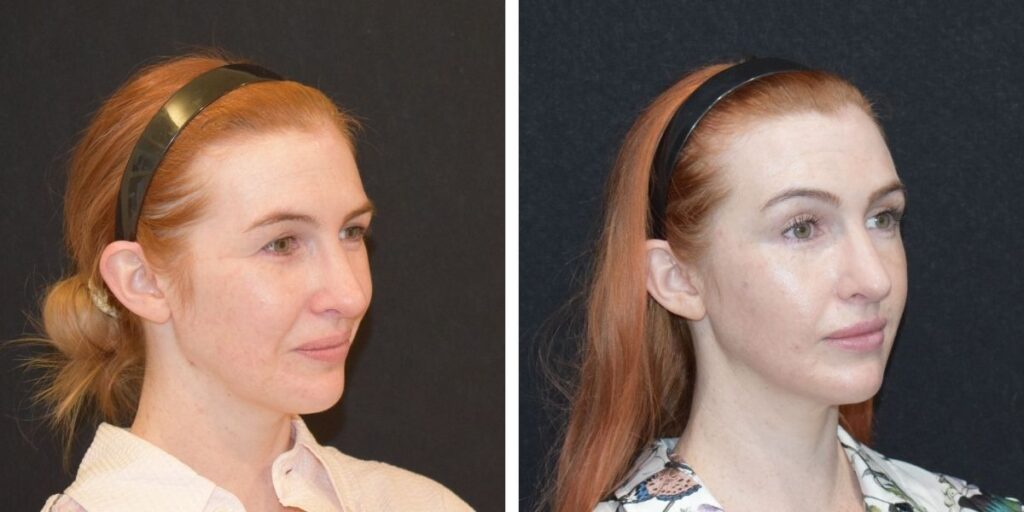 Side-by-side portraits of a woman with red hair and a headband, showing her profile on the left and facing forward on the right against a black background. Saxon MD
