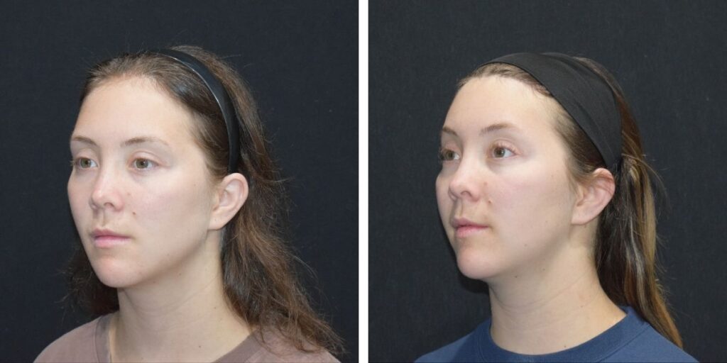Side-by-side comparison of a woman's profile from the left and right side against a black background. Saxon MD
