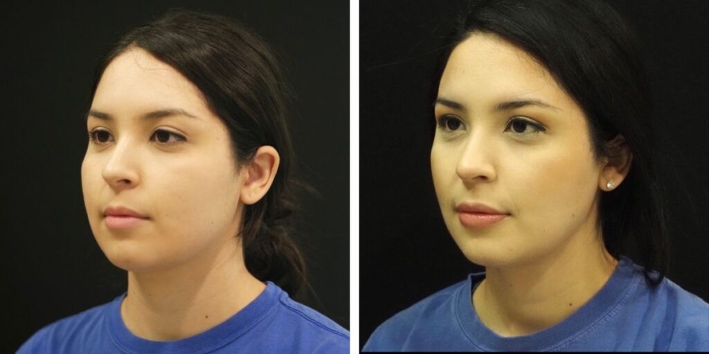 Split image of a woman shown in profile from her left and right side, each against a black background, wearing a blue t-shirt. Saxon MD