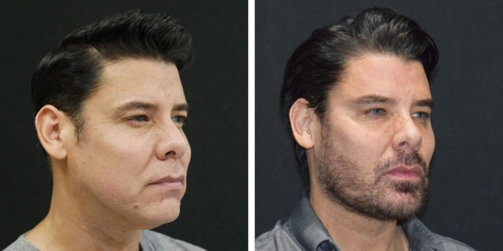 Side-by-side profile views of a man before and after hair styling, showing sleek hair combed back in the after photo. Saxon MD
