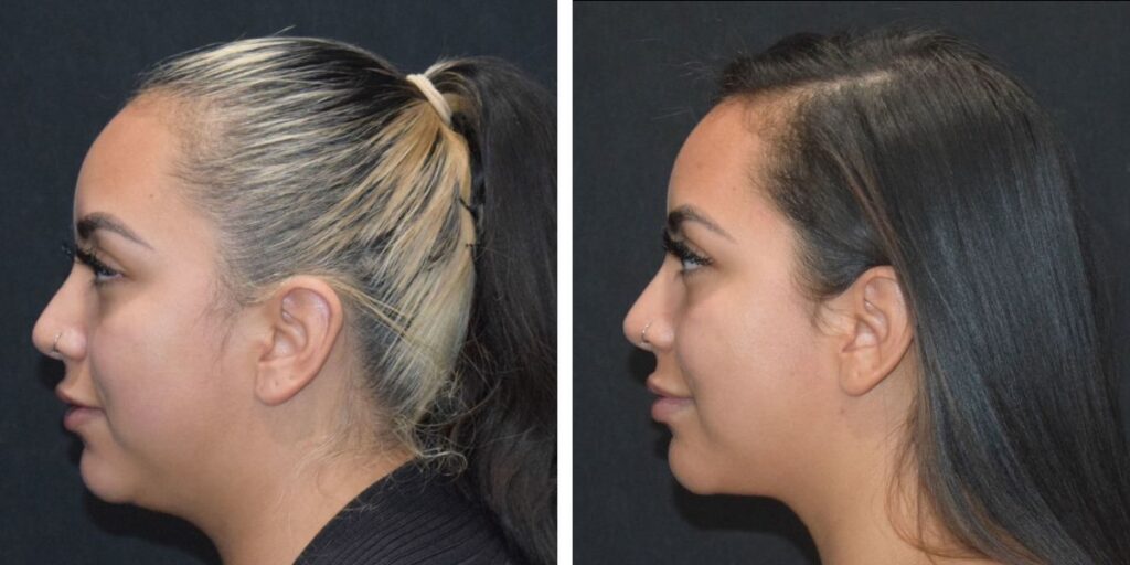 Side profile views of a woman with blonde and black hair tied in a ponytail, showcasing a left and right profile against a black background. Saxon MD