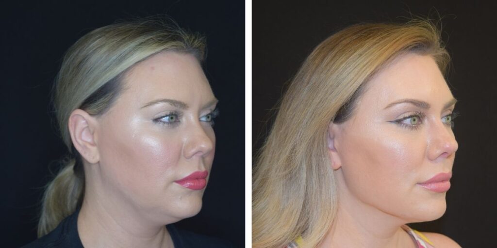 Before and after side profile photos of a woman with makeup, highlighting enhanced facial features and smoother skin. Saxon MD