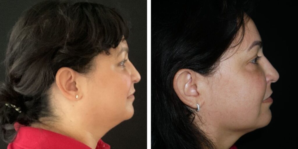 Side-by-side profile views of a woman with dark hair, one image showing her face illuminated, the other in shadow. Saxon MD