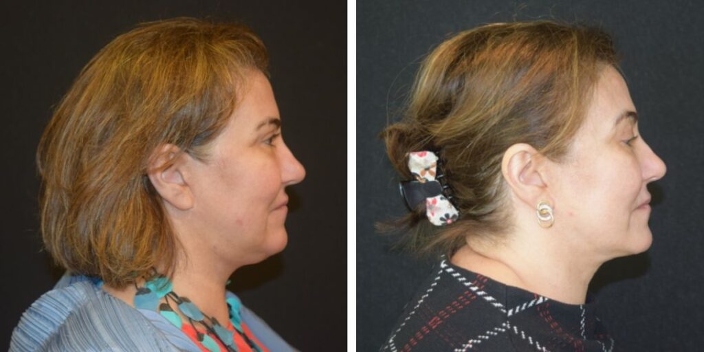 Side profile views of a woman with short hair, one showing her in a patterned blue top and the other in a black and red top, both against a black background. Saxon MD