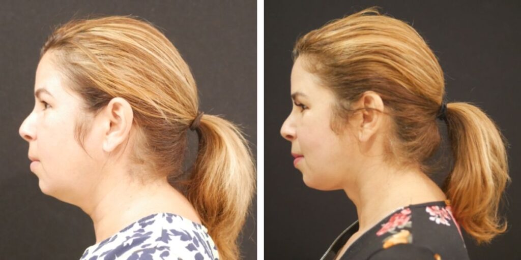 Side profile comparison of a woman with brown hair in a ponytail, first image showing her facing left, second showing her facing right, against a black background. Saxon MD