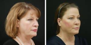 facetite before and after photo of a patient at Saxon MD in Austin and Dallas, TX to compare thread lift vs facetite