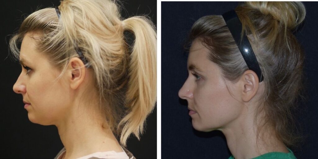 Side-by-side comparison of a woman with two different hairstyles: loose ponytail on the left and ponytail with a black headband on the right. Saxon MD