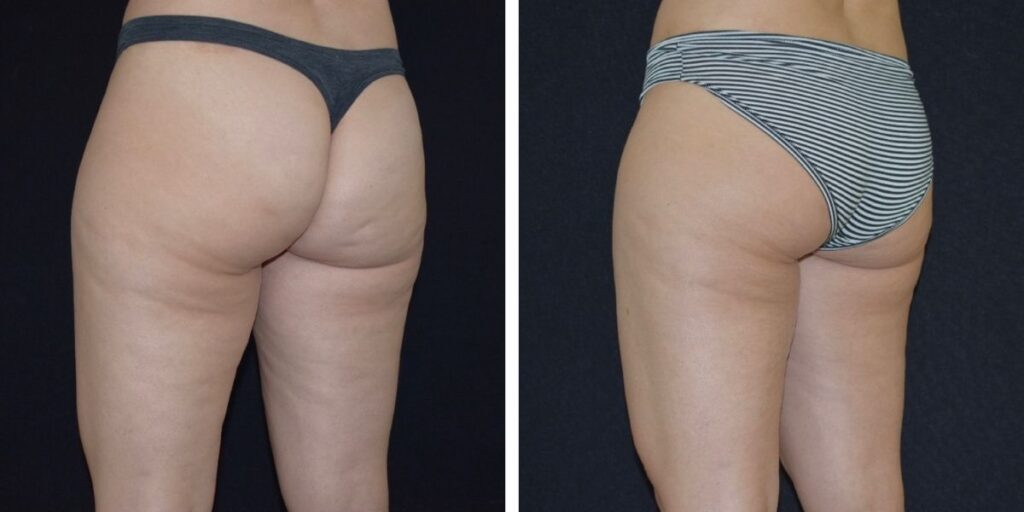 Before and after comparison of a woman's thighs and buttocks, showing visible cellulite reduction and smoother skin. Saxon MD
