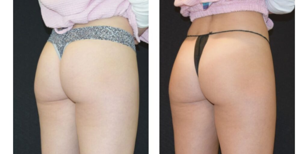 Before and after comparison of buttocks appearance, each image showing a person turned away and wearing different styled underwear, against a dark background. Saxon MD