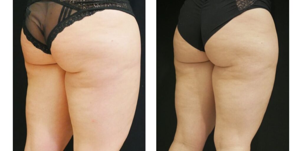 Side-by-side comparison of a person's thighs and buttocks before and after a cosmetic or medical treatment, showing noticeable changes in skin texture and contour. Saxon MD