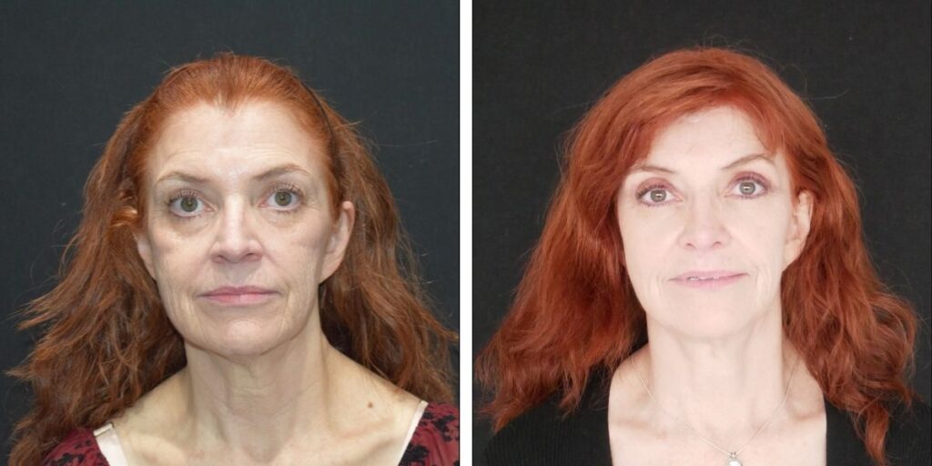Before and after comparison of a middle-aged woman with red hair, showing a change in hairstyle and expression, against a neutral background. Saxon MD