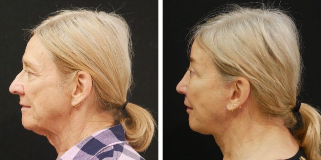 Side profile images of an elderly woman with blonde hair, before and after styling, against a black background. Saxon MD