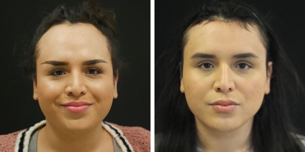 Side-by-side portraits of a woman before and after makeup removal, highlighting differences in facial features and skin tone. Saxon MD