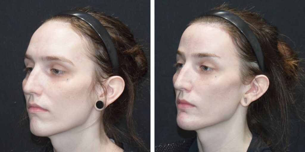Side profile of a woman with a black headband, facing left in both images, against a black background. Saxon MD