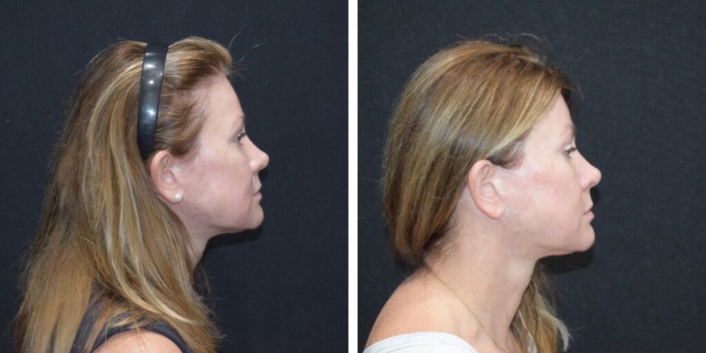 Side profile views of two different women against a black background, one image showing a woman with a headband, and the other without. Saxon MD