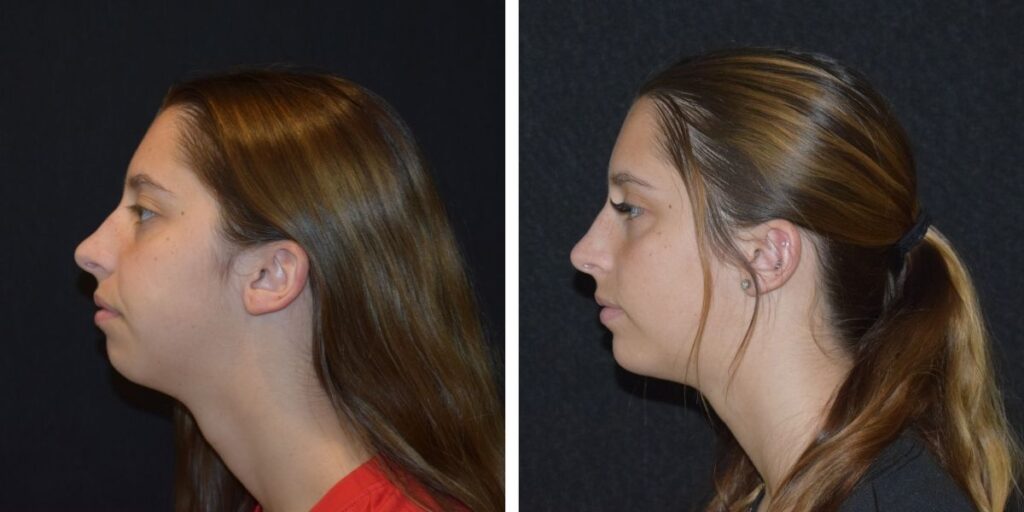 Profile views of a young woman with brown hair, one with hair tied back and the other with hair down, against a black background. Saxon MD