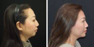 Before and after photo of a patient after a chin implant was placed and rhinoplasty at Saxon MD; side profile