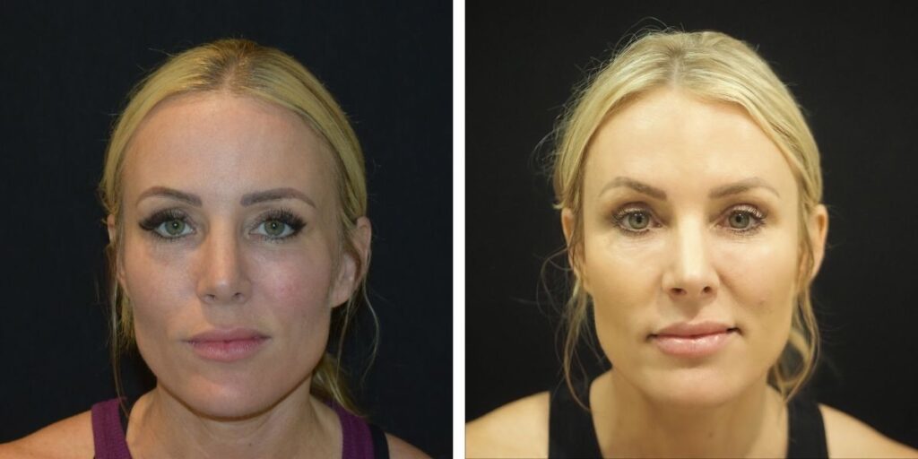 Side-by-side front-facing portraits of a woman with blonde hair before and after makeup, set against a black background. Saxon MD