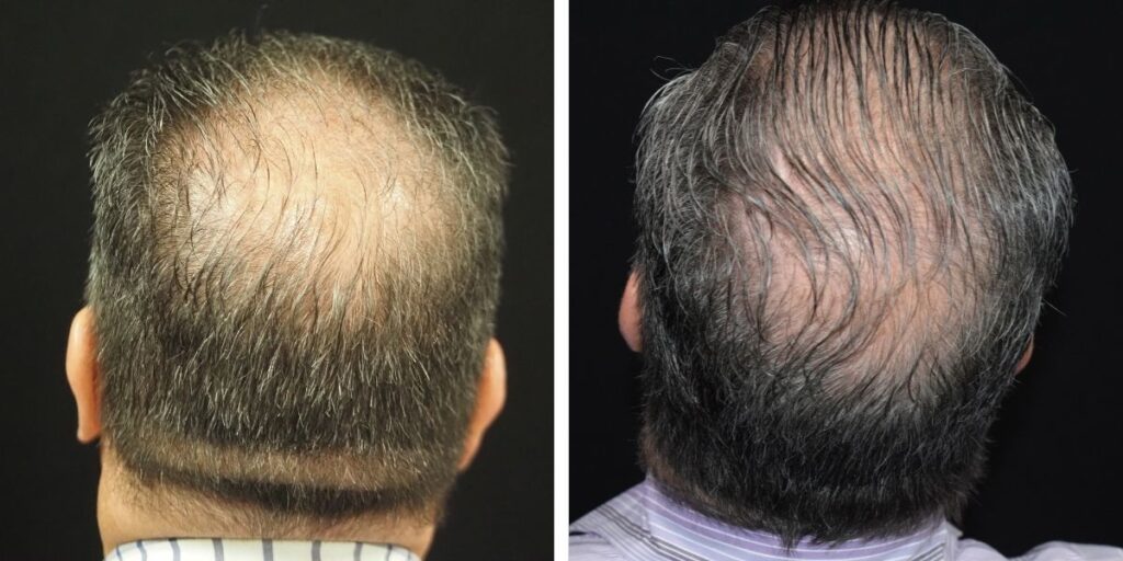 Before and after comparison of a man's crown showing hair regrowth; the left image shows significant hair thinning, the right shows denser hair. Saxon MD
