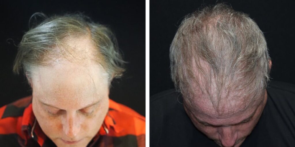 Before and after comparison of a man's scalp showing hair loss and slight regrowth, top view. Saxon MD