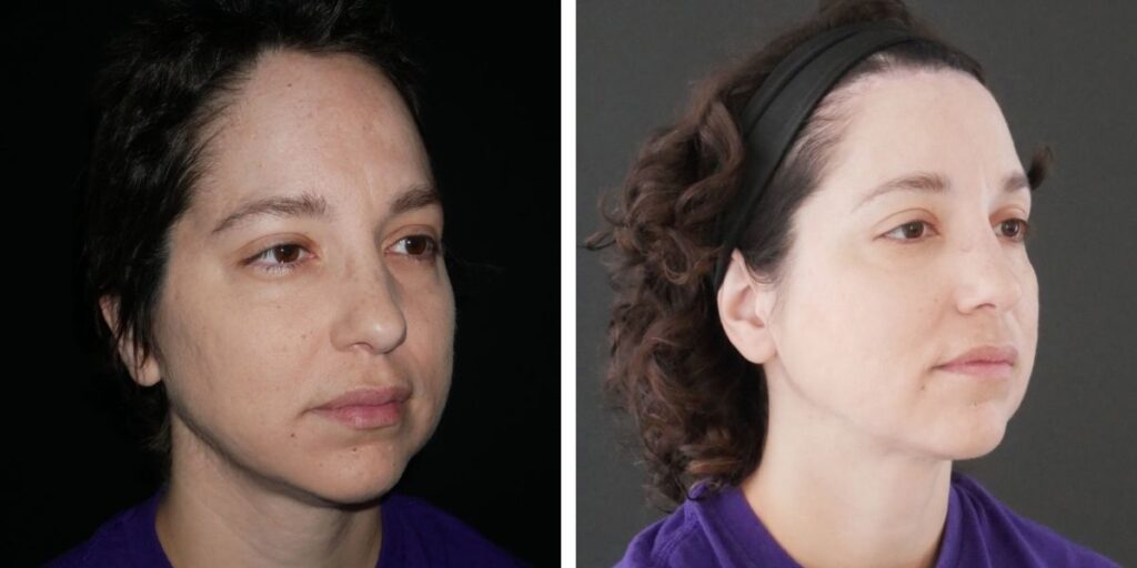 Side-by-side portraits of a woman with brown hair before and after styling with a headband; left shows her face in profile and right shows a frontal view. Saxon MD