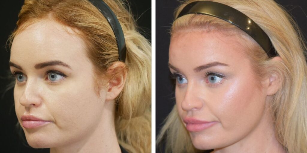 Side-by-side comparison of a woman's face before and after makeup, highlighting enhanced facial features and skin tone. Saxon MD