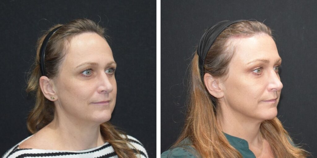 Two side-by-side profile photos of a woman with light brown hair, showcasing her face from different angles against a black background. Saxon MD