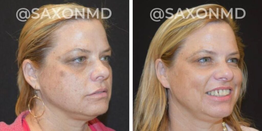 Before and after photos of a woman, showing a side and front view, with visible improvement in skin and facial features, tagged with "@saxonmd". Saxon MD