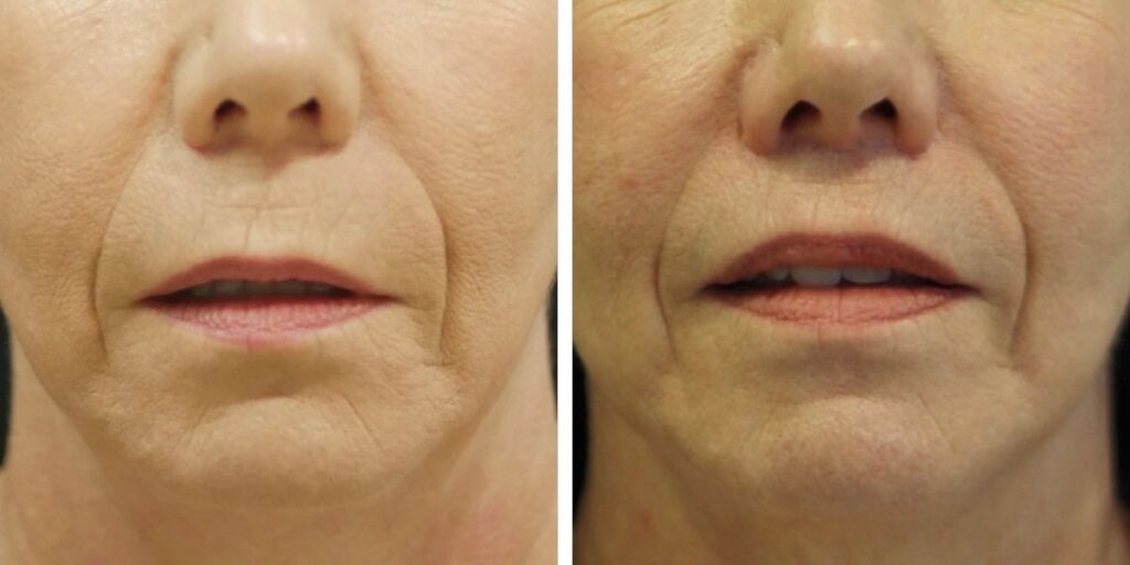 Before and after close-up photos of a woman's lower face showing reduced wrinkles and smoother skin around the mouth. Saxon MD