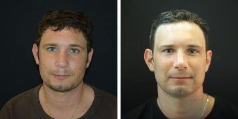 Before and after Morpheus8 radiofrequency microneedling, front view, by Austin facial plastic surgeon Dr. Sarah Saxon