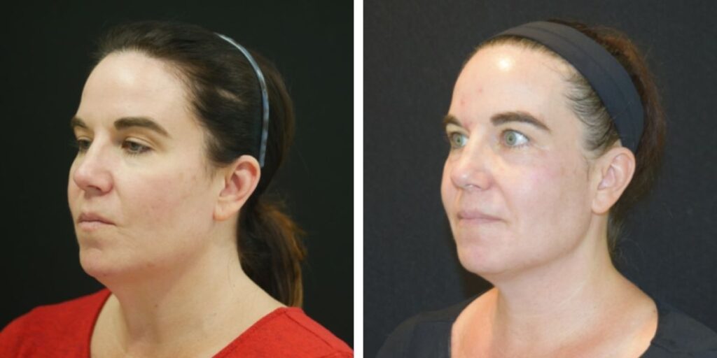 Side-by-side profile and three-quarter view of a woman with dark hair pulled back, wearing a headband and a red top, against a black background. Saxon MD