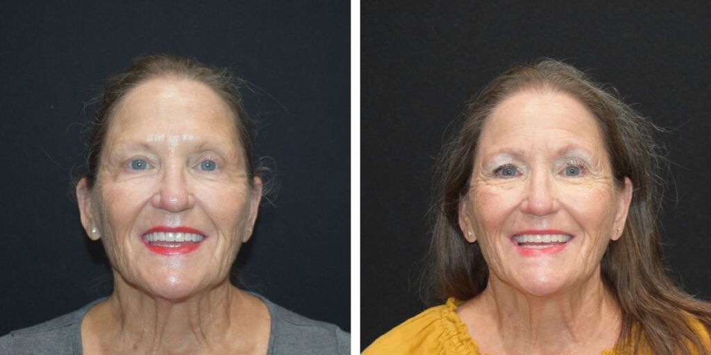 Before and after comparison of a smiling elderly woman with makeup transformation, posing against a dark background. Saxon MD