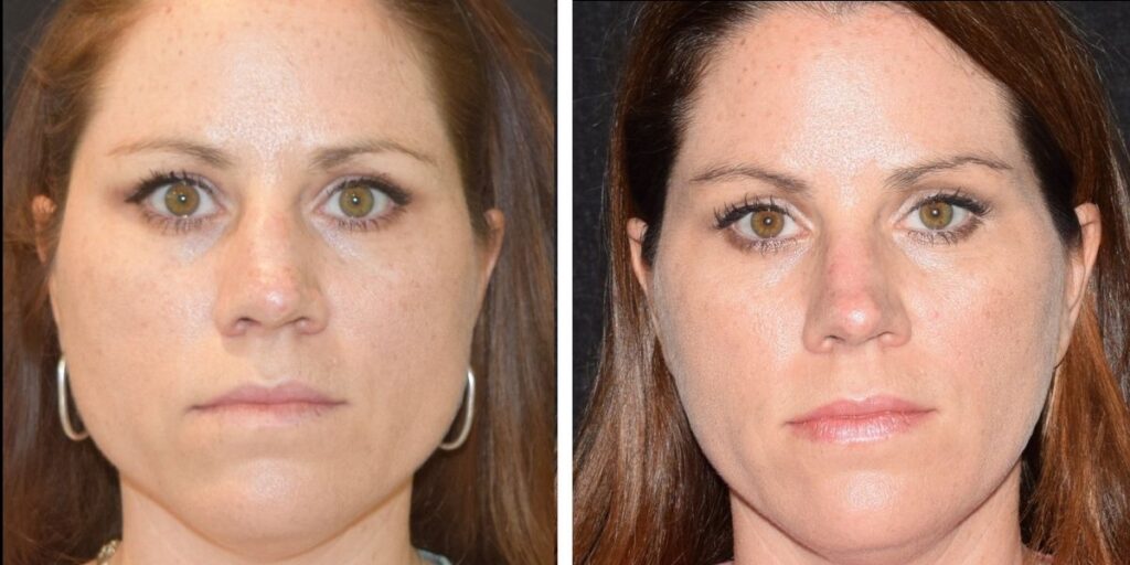 Frontal facial comparison of a woman with subtle changes in appearance, focusing on eyes and skin texture, against a neutral background. Saxon MD