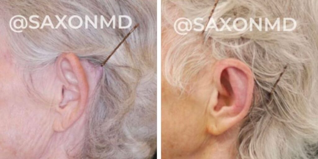 Two side-by-side images showing the profile of an elderly person's ear, before and after a cosmetic procedure, with noticeable improvements in skin texture and clarity. Saxon MD