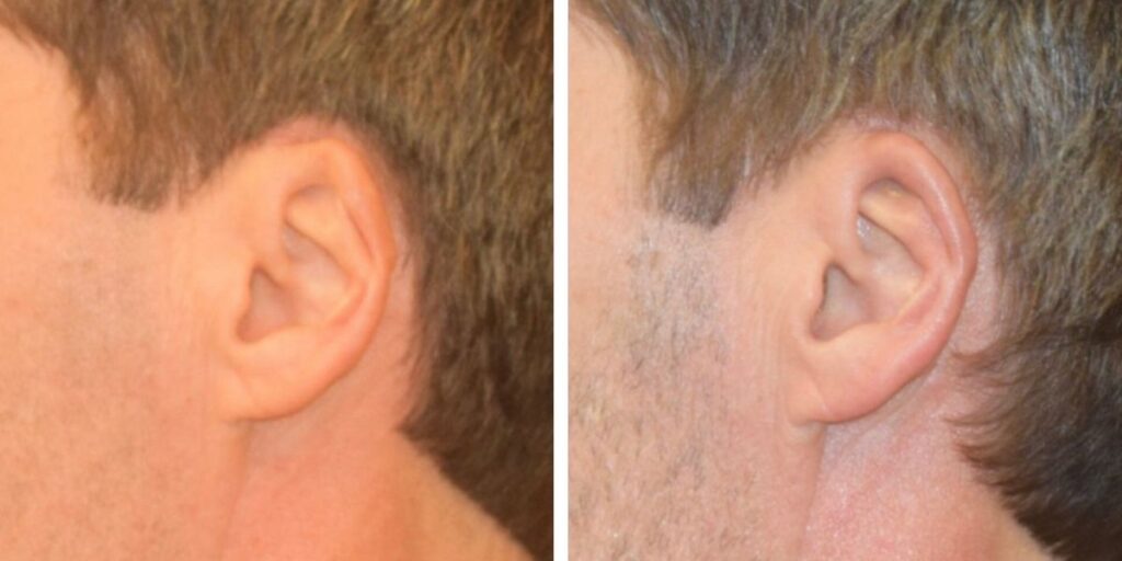 Side-by-side comparison of a man's ears, showing the right ear from two angles, with visible differences in shape and structure. Saxon MD