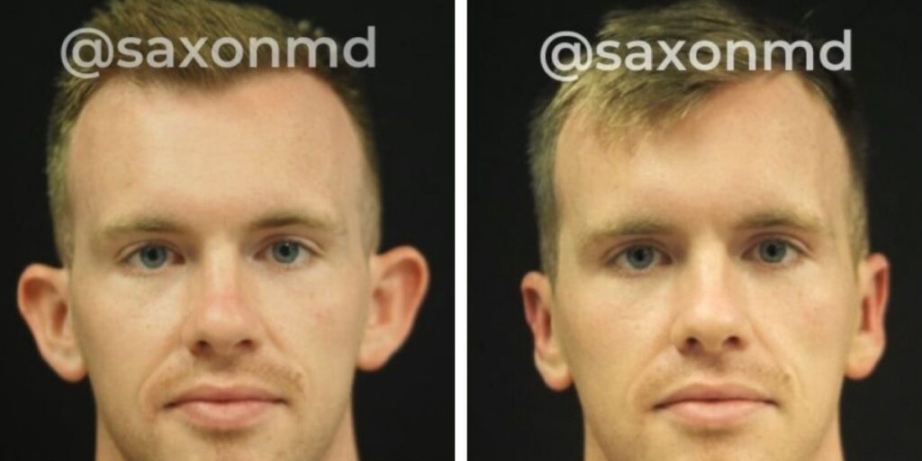 Two side-by-side portraits of the same man with a subtle expression change, tagged with "@saxonmd" on each image. Saxon MD