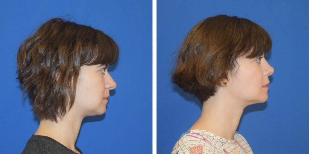 Profile views of a woman with short hair before and after a haircut, against a blue background. Saxon MD