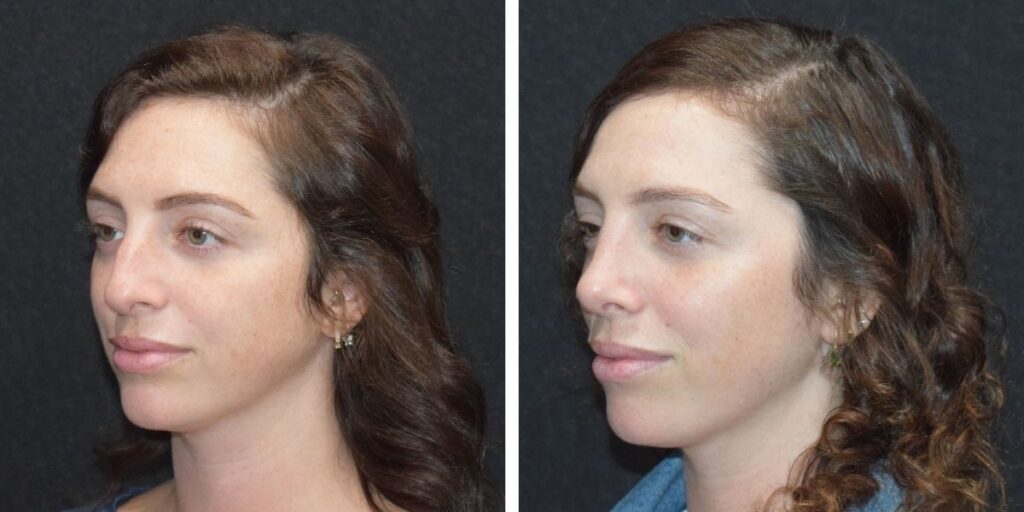 Side-by-side profile views of a woman with brown hair, featuring her left and right sides against a black background. Saxon MD
